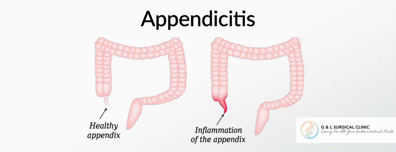 Appendicits, Inflammation of the Appendix, G&L Surgical Clinic, Dr Ganesh Ramalingam